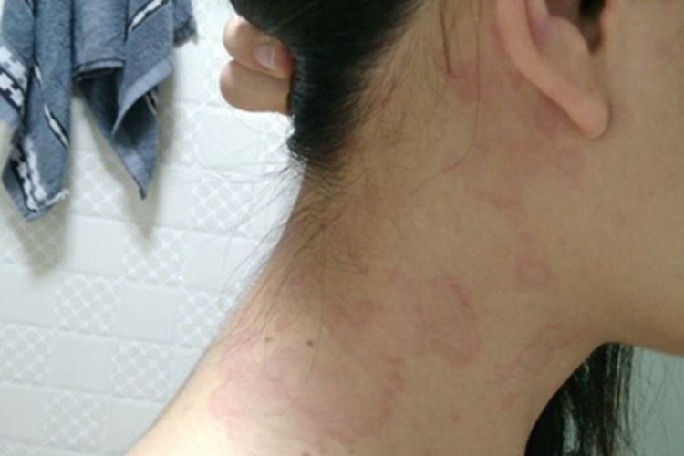 荨麻疹型药疹侧颈红斑图