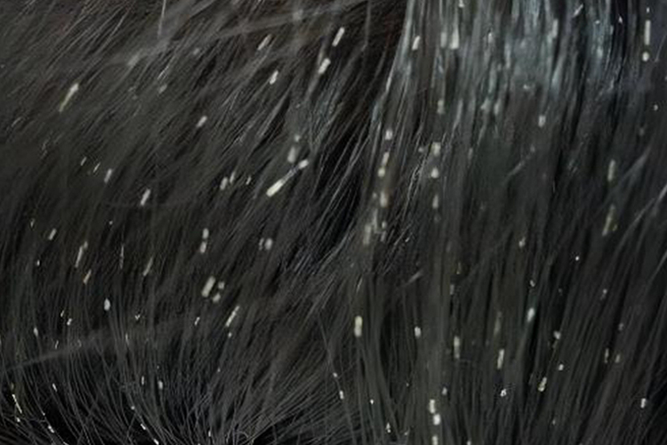 小孩管型毛发图 小孩管型毛发图