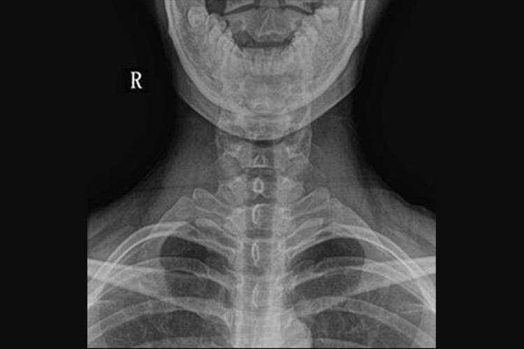 颈椎正位片图