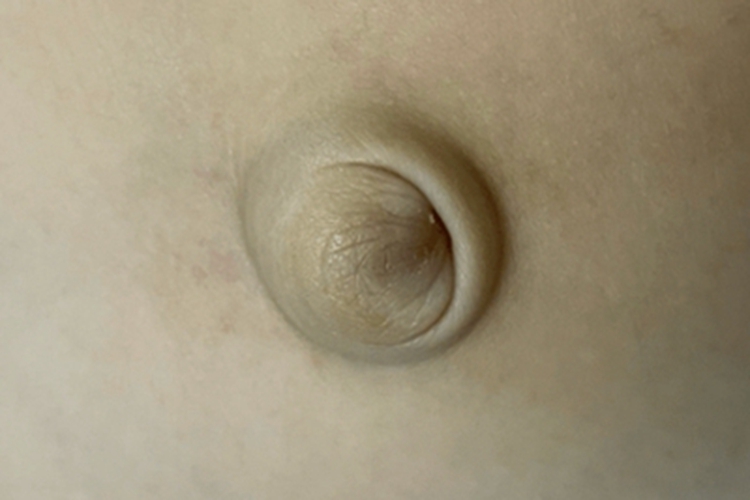 成人脐疝症状图 成人脐疝症状图