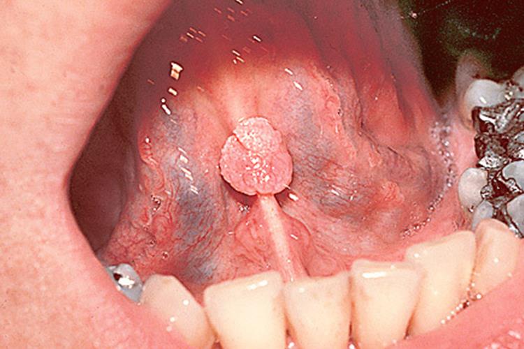 口腔菜花状尖锐湿疣图