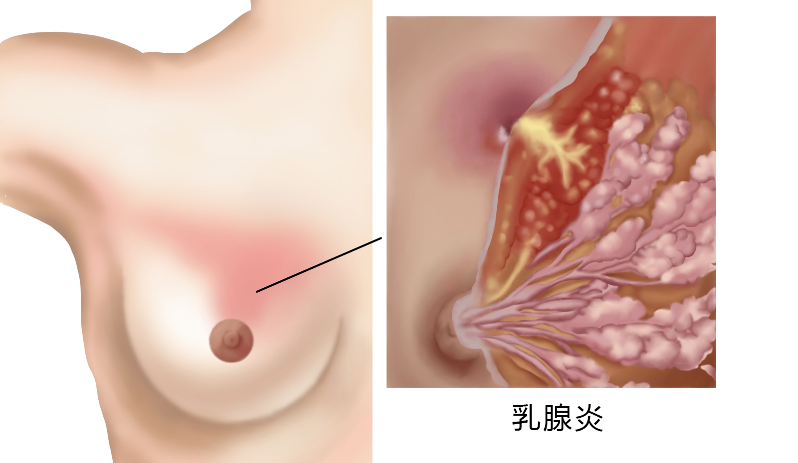 乳腺炎图