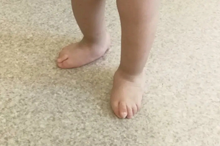 先天性垂直距骨走路时脚趾外翻图 先天性垂直距骨走路时脚趾外翻图