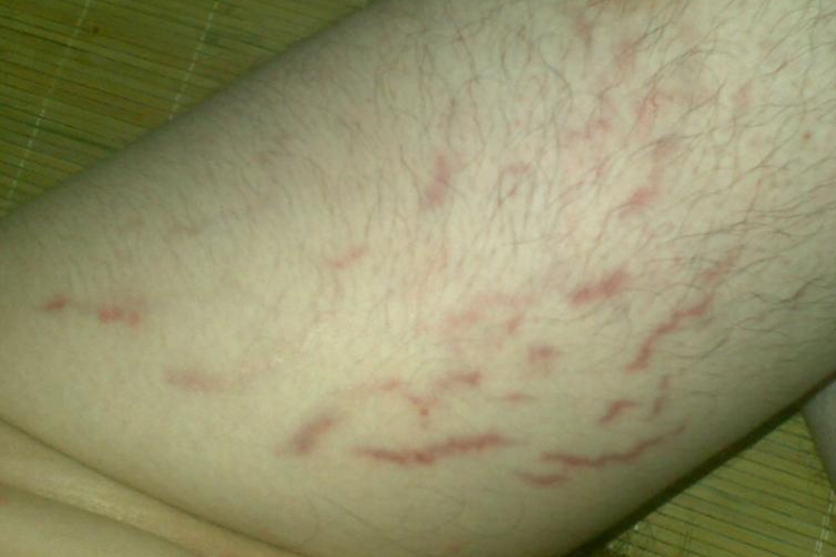 腹股沟附近萎缩纹图