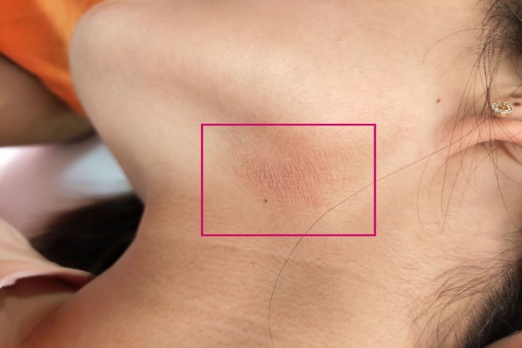 颈部假性皮萎缩侧颈纹图