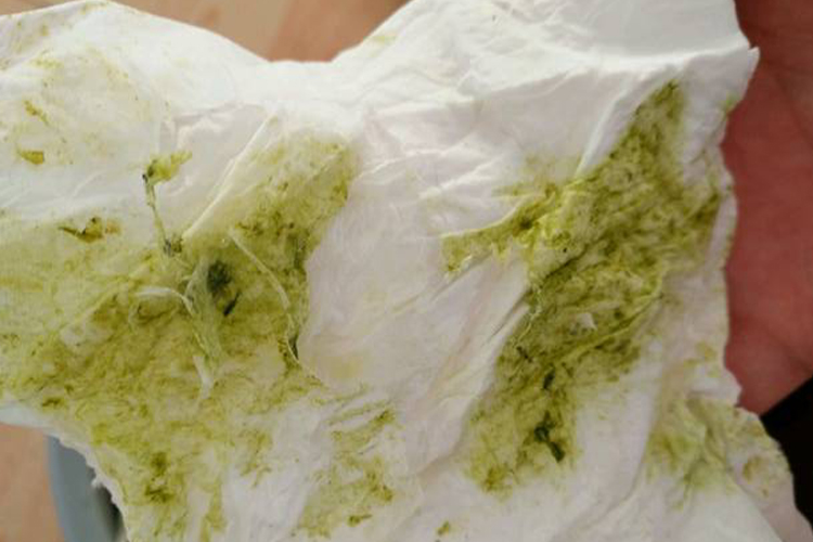 呕吐出墨绿色胆汁图 呕吐出墨绿色胆汁图