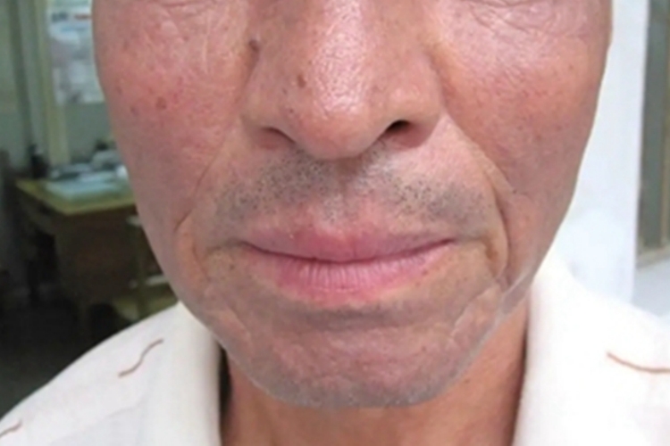 职业性黑变病面部红肿图