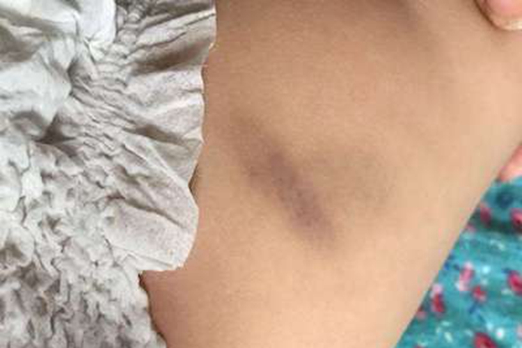 瘀斑臀部一小片青紫斑图 瘀斑臀部一小片青紫斑图