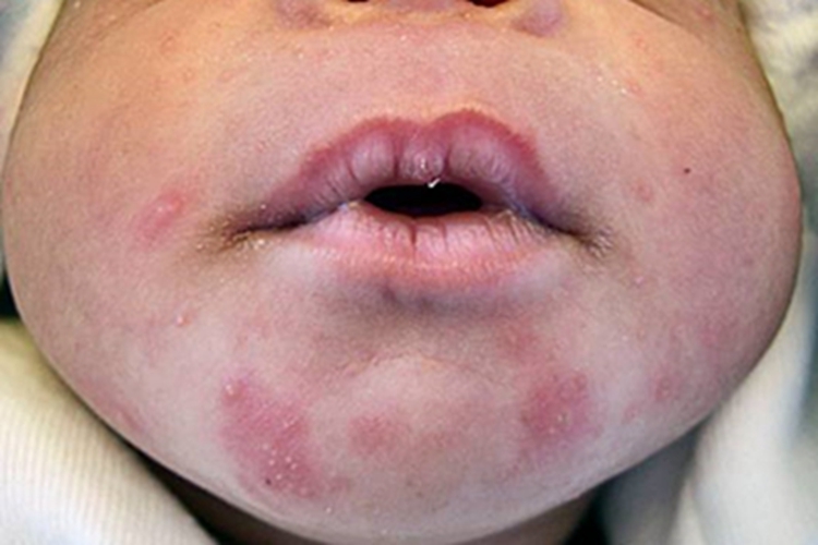 毒性红斑脸上有红斑小疹子图