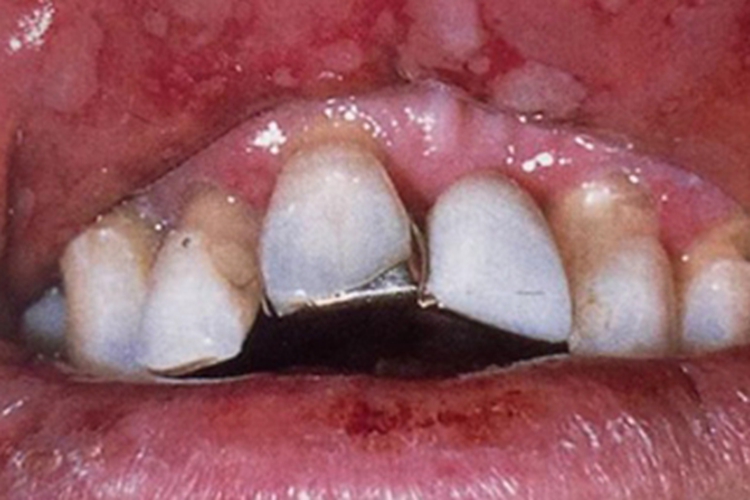 疱疹样溃疡唇内侧溃疡图