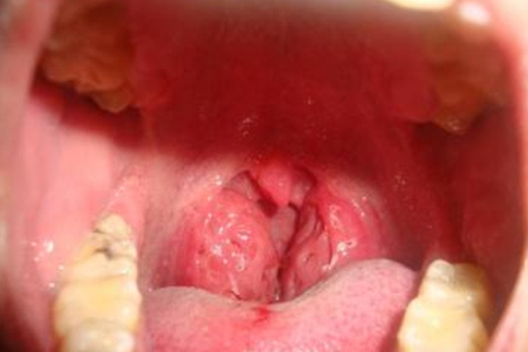 慢性扁桃体炎蜂窝状图