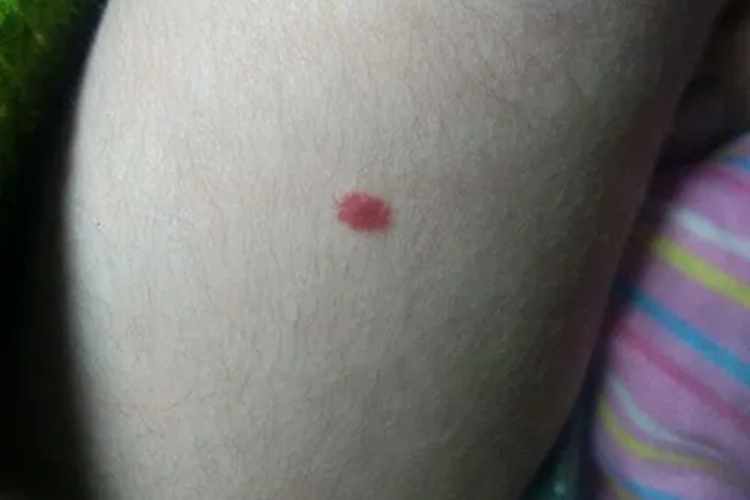 樱桃状血管瘤红斑图