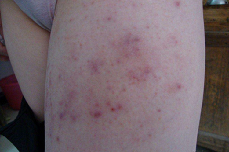 难辨认癣大腿疙瘩图 难辨认癣大腿疙瘩图