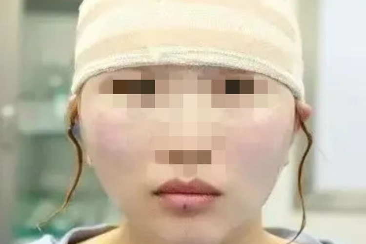 大拉皮手术15天切口应用弹力敷料图