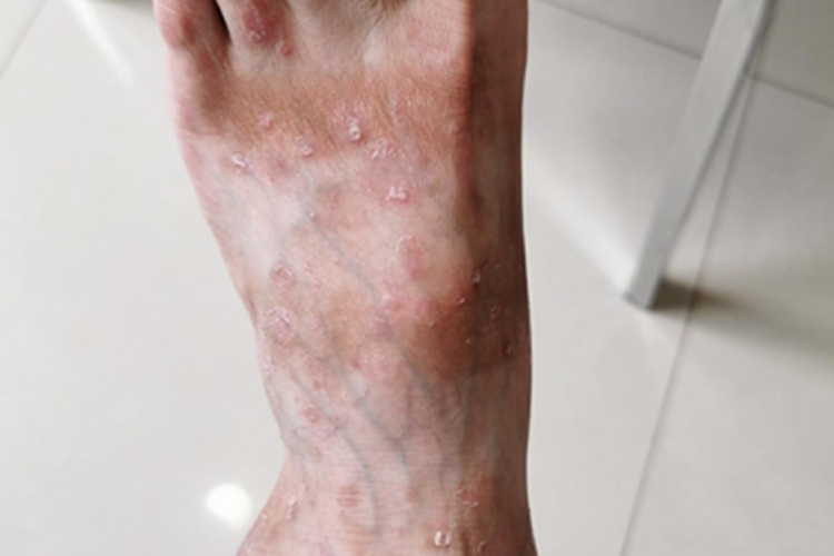 寻常型银屑病脚背症状图