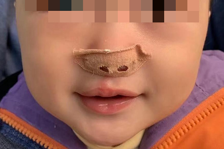 腭裂手术后一年后恢复图