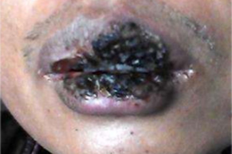 坏死性溃疡性龈口炎嘴唇症状图 坏死性溃疡性龈口炎嘴唇症状图