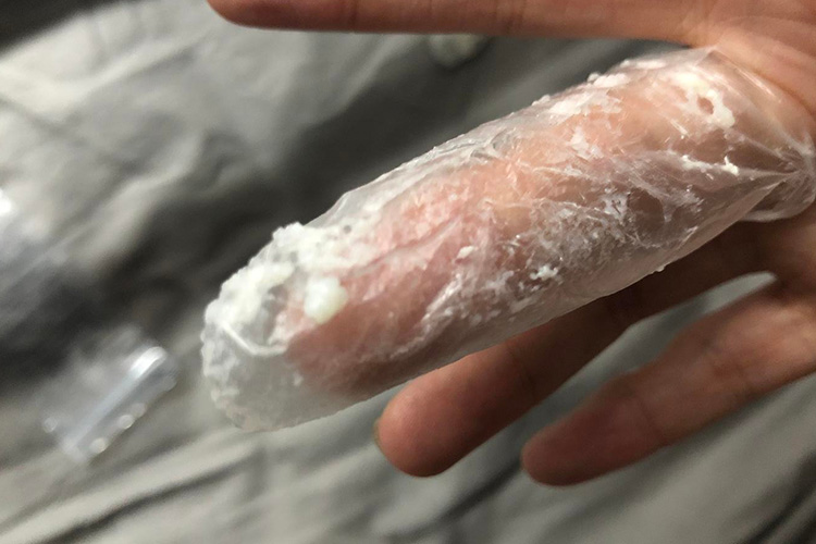 外阴阴道假丝酵母菌病:白带白色稠厚,呈凝乳状或豆腐渣样,妇科检查