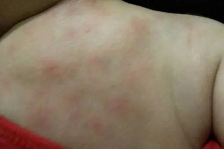 新生儿红斑后背上有红斑图