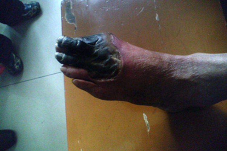 坏疽脚趾红肿图