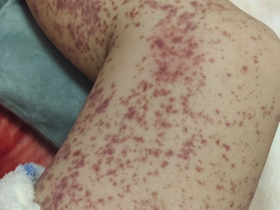 单纯性紫癜腿上密集小红点图.jpg