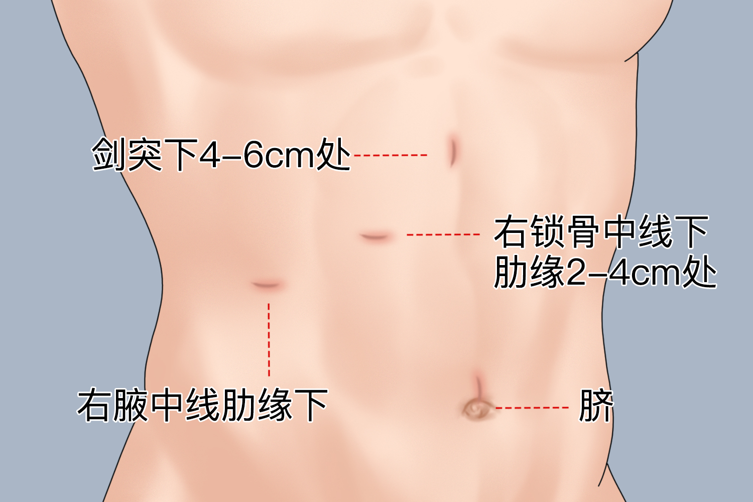胆结石手术打四孔位置图 胆结石手术打四孔位置图