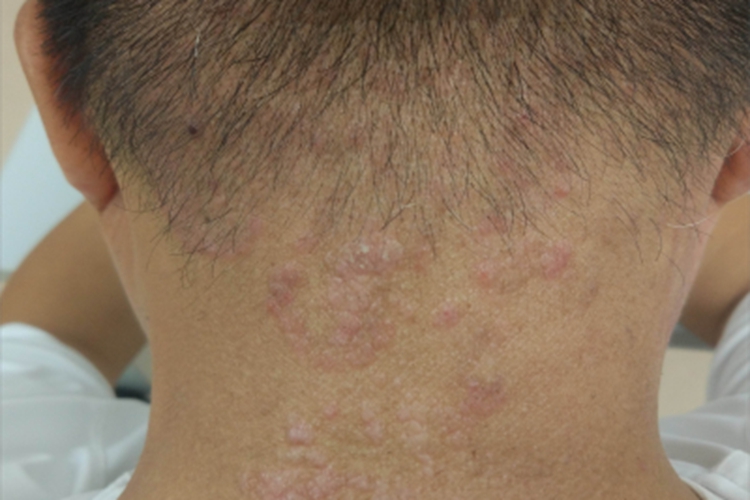 难辨认癣后颈丘疹图