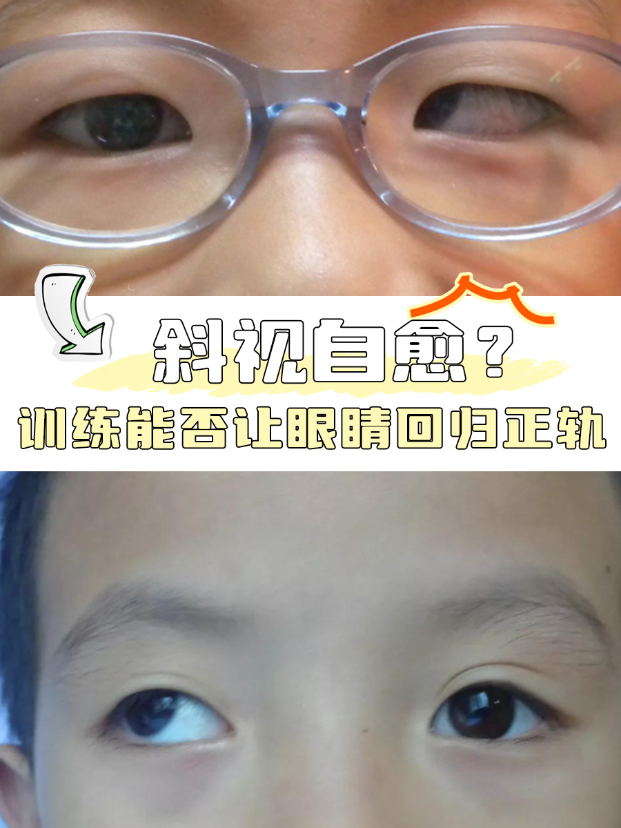 斜视自愈？训练能否让眼睛回归正轨