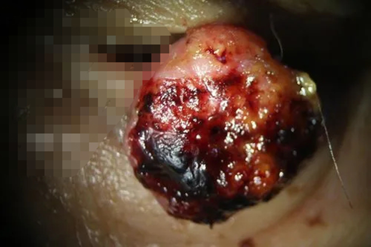 眼睑鳞状细胞癌图 眼睑鳞状细胞癌图