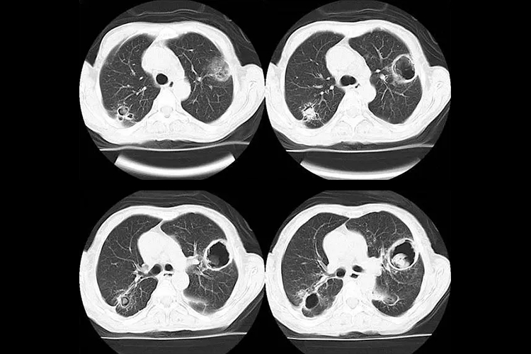 肺曲霉菌病CT图 肺曲霉菌病CT图