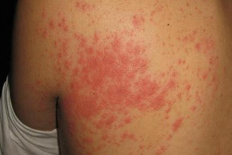 螨虫皮炎背部丘疹图