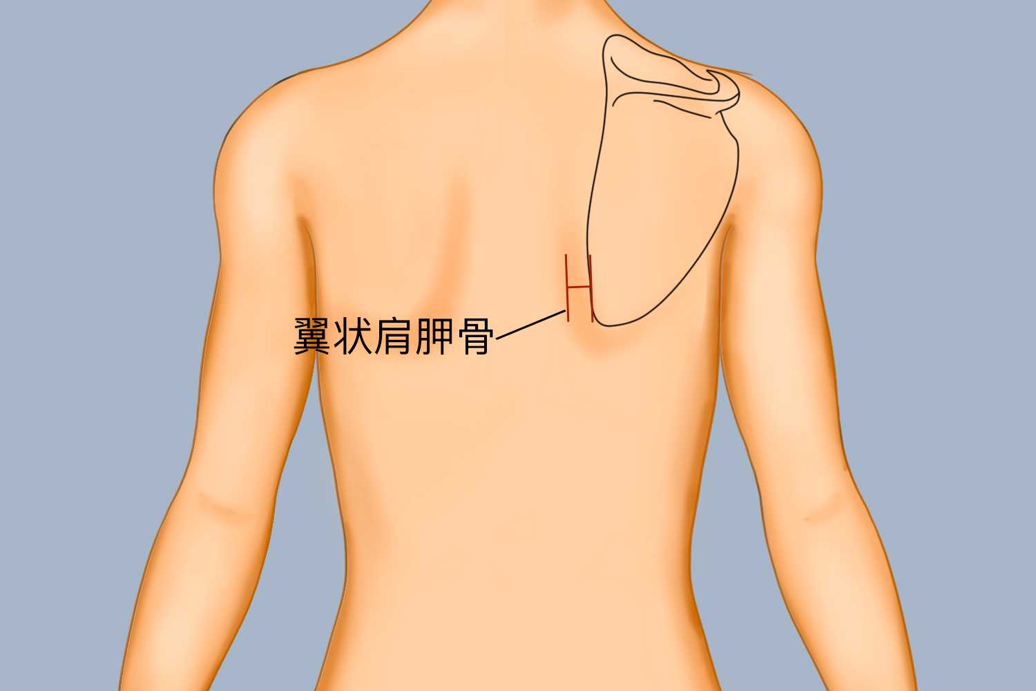 翼状肩胛骨图