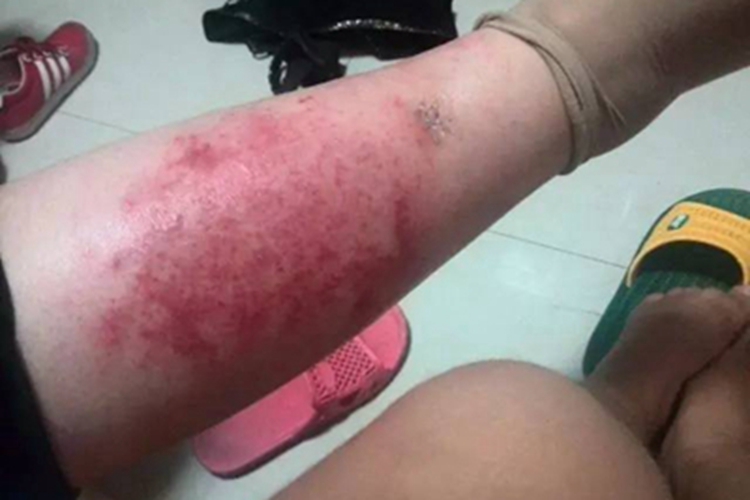 急性网状淋巴管炎小腿症状图