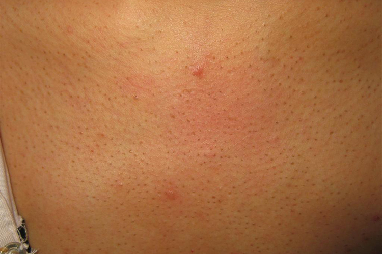 胸前黑头粉刺图