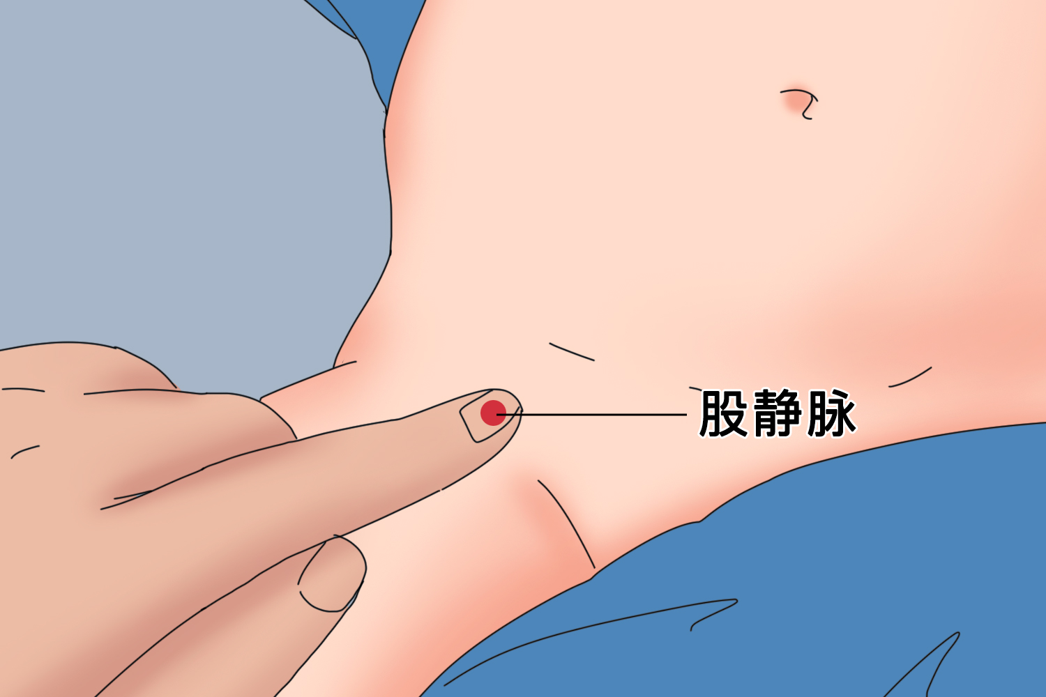 股静脉定位方法示意图图片