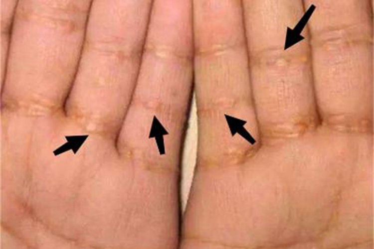 结节性黄瘤手部结节图