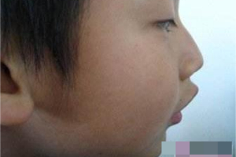 小儿生长激素缺乏症嘴唇症状图