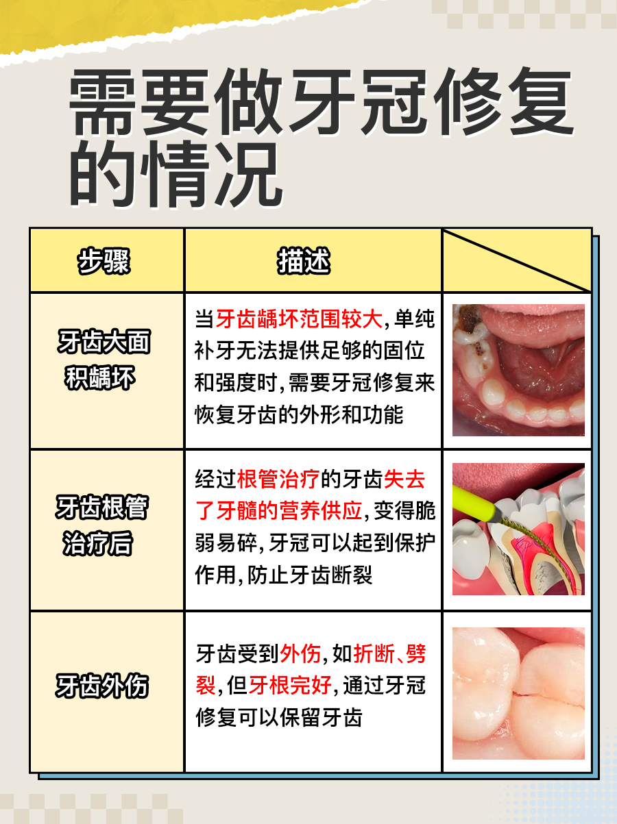 牙冠修复过程图解