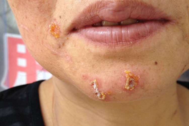 老人脸上脓疱疮图