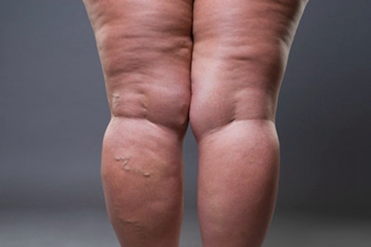 甲状腺功能减退症小腿水肿图