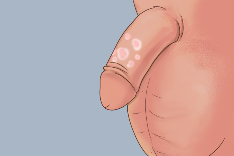 接触性阴茎皮炎图