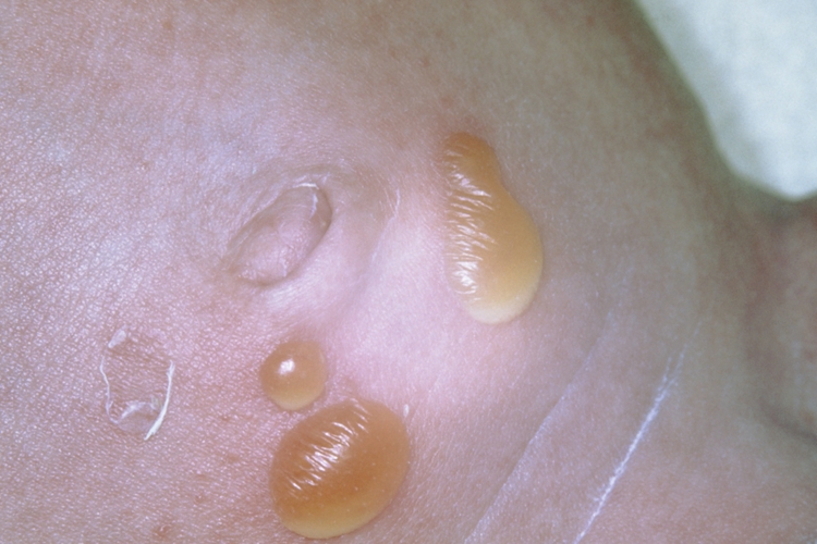 大疱性脓疱疮图