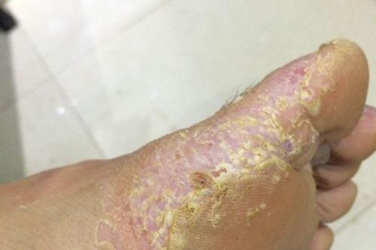 脚白色念珠菌感染图