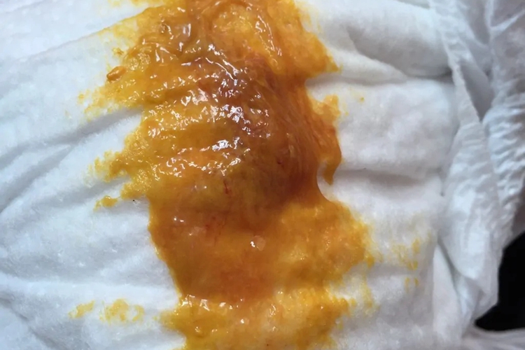 吃黄桃过敏腹泻图