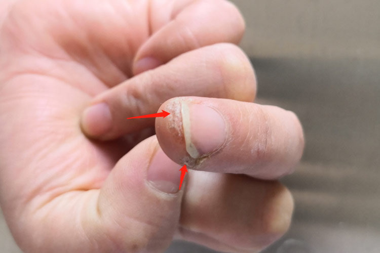 甲下疣指甲下边长丘疹图