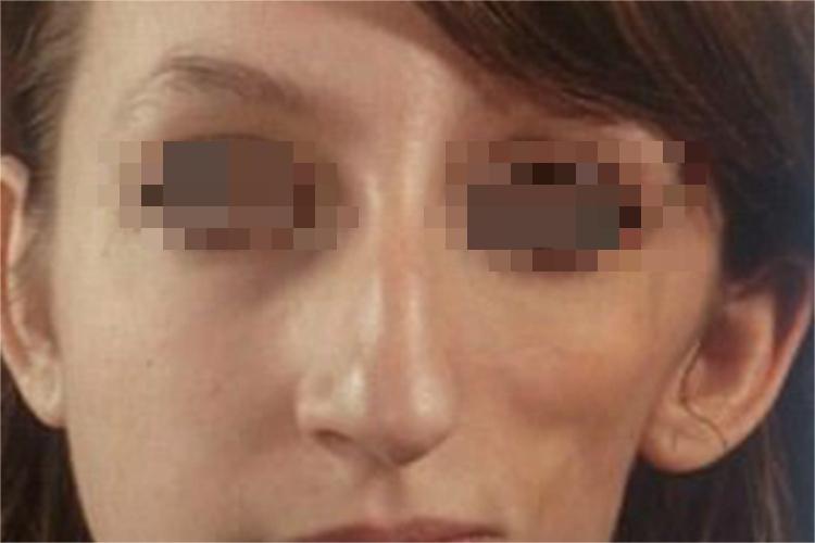 进行性单侧面萎缩面部萎缩图