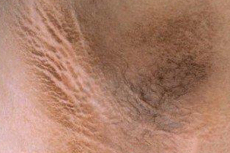 假性黑棘皮病纹图 假性黑棘皮病纹图