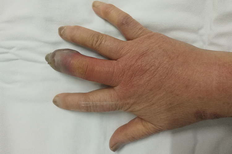 糖尿病手病变症状图