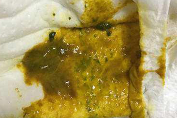 婴儿感染性腹泻大便排出黏液图