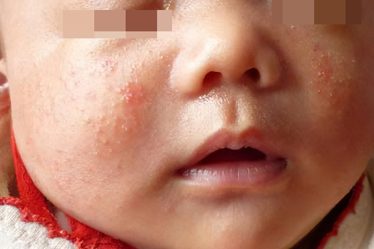 婴儿面部白痱图 婴儿面部白痱图